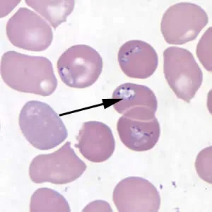 Babesia organisms highlighted in a blood smear