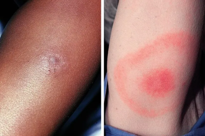 Erythema migrans rash on different skin tones