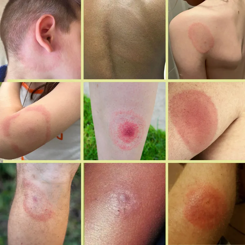 Collage showing different erythema migrans rash appearances