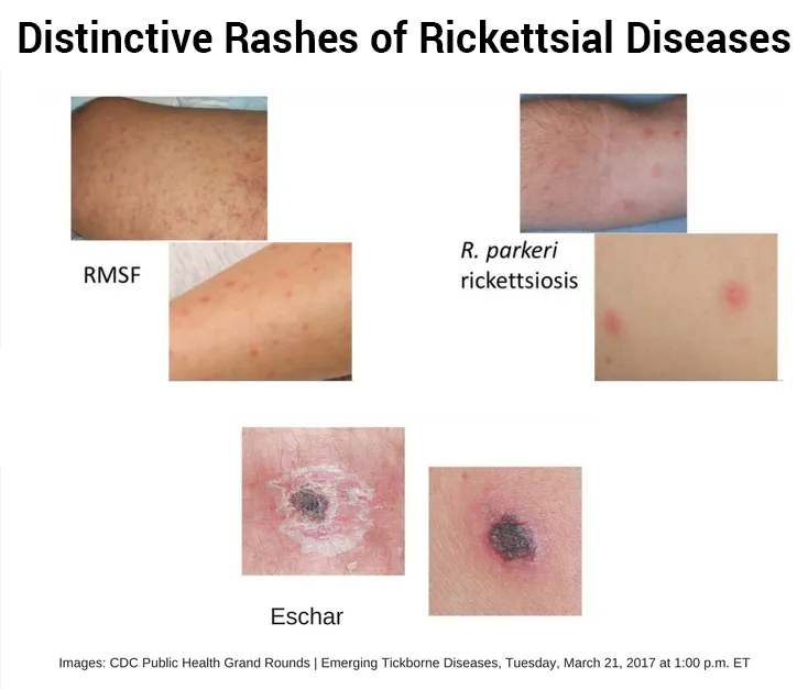 Examples of distinctive rashes associated with rickettsial diseases